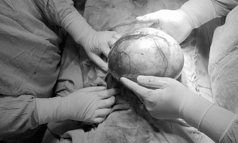 बुरहानपुर-में-डॉक्टरों-का-मिरेकल:-57-वर्षीय-महिला-के-पेट-से-8-किलो-का-ट्यूमर-निकाला