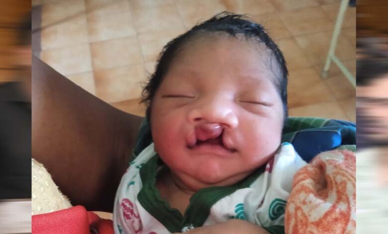 जब-चिरायु-टीम-बनी-एक-परिवार-की-उम्मीद,-जन्मजात-विकृति-से-जूझ-रहे-बच्चे-को-मिला-नया-जीवन